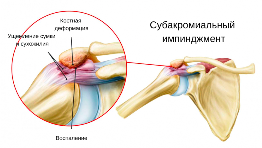 Субакромиальный импинджмент