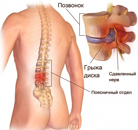 Защемление нерва